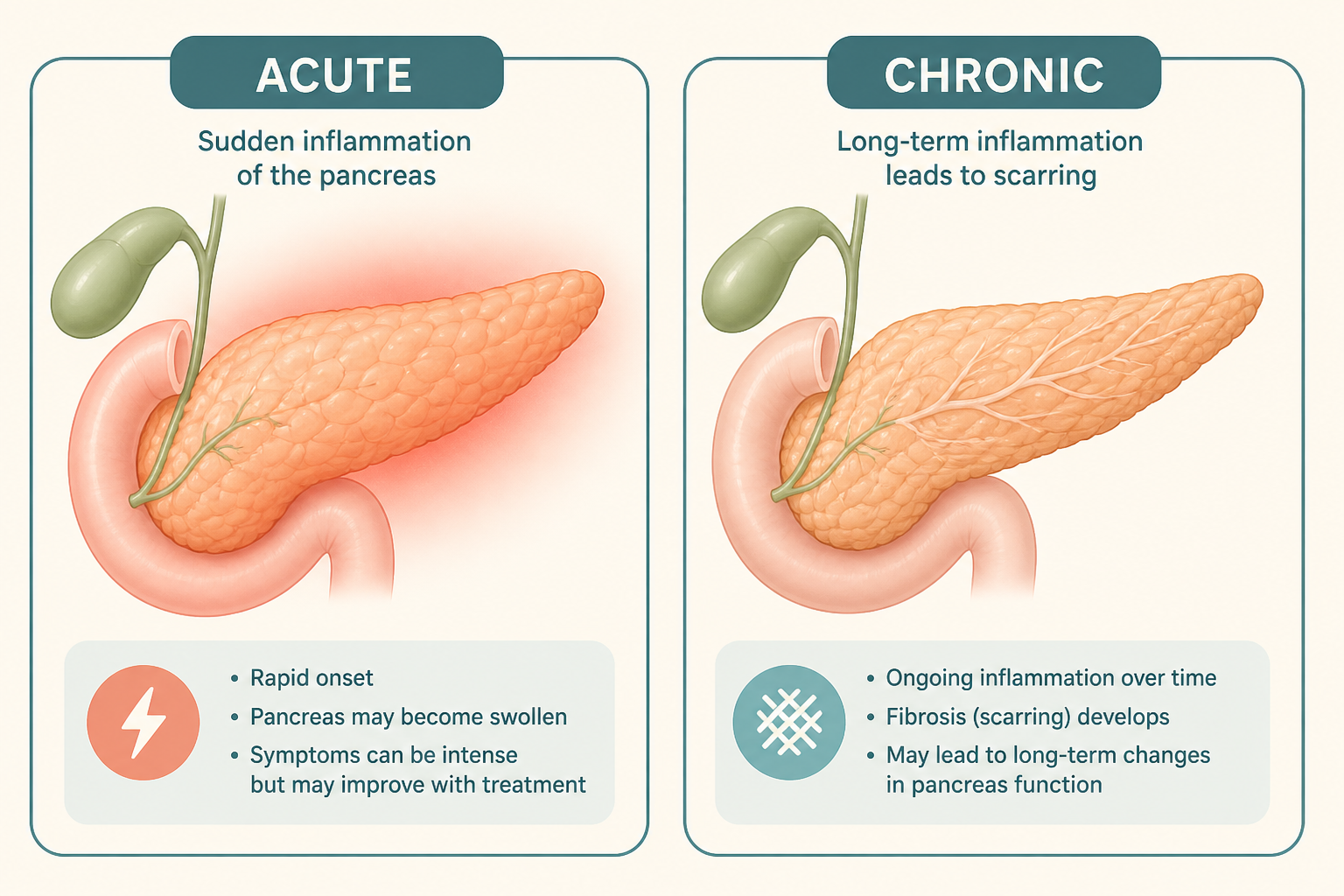 Side-by-side comparison of acute pancreatitis (sudden attack) and chronic pancreatitis (lasting damage).
