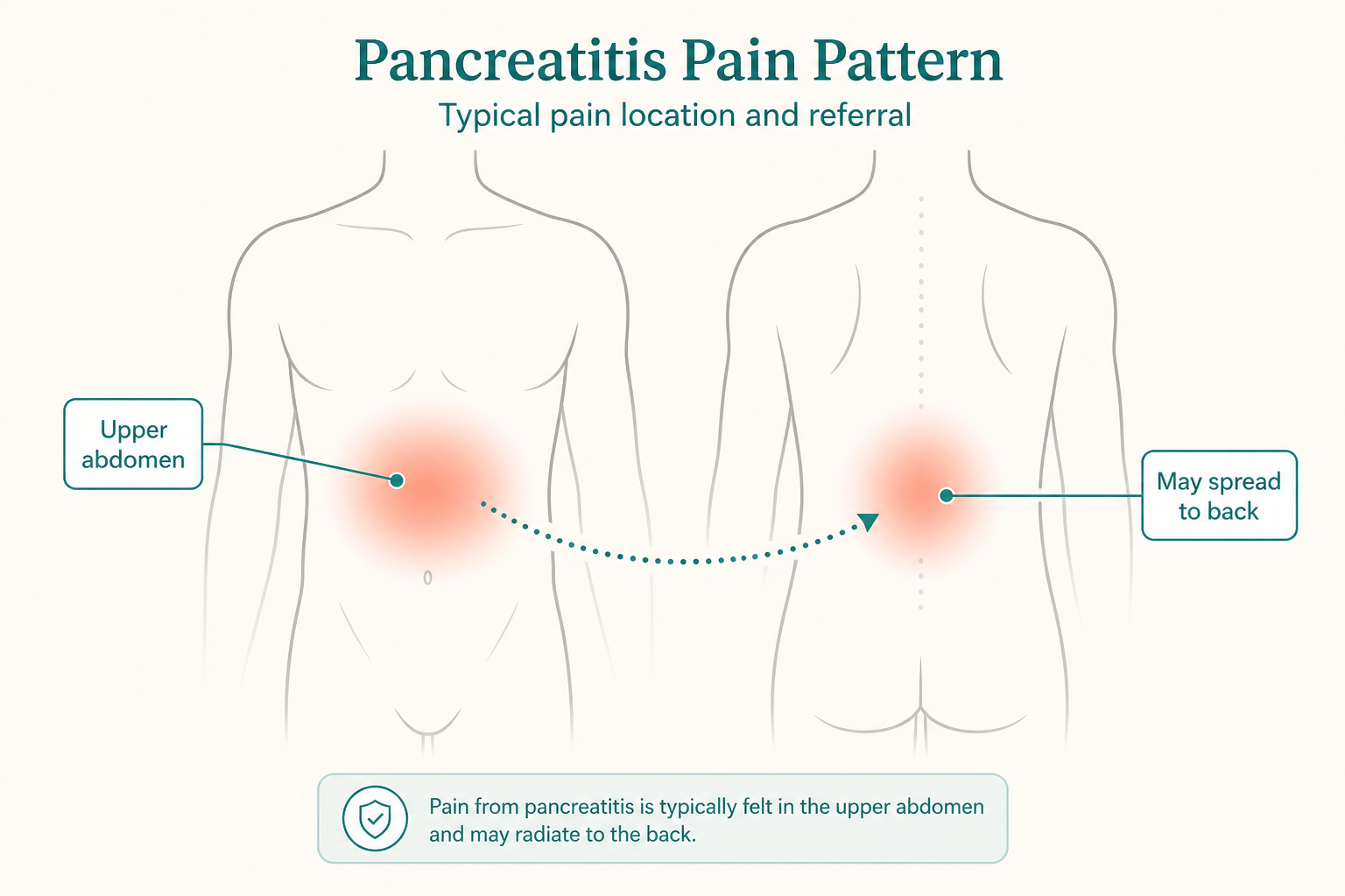 Diagram of typical pancreatitis pain in the upper abdomen that may spread to the back.